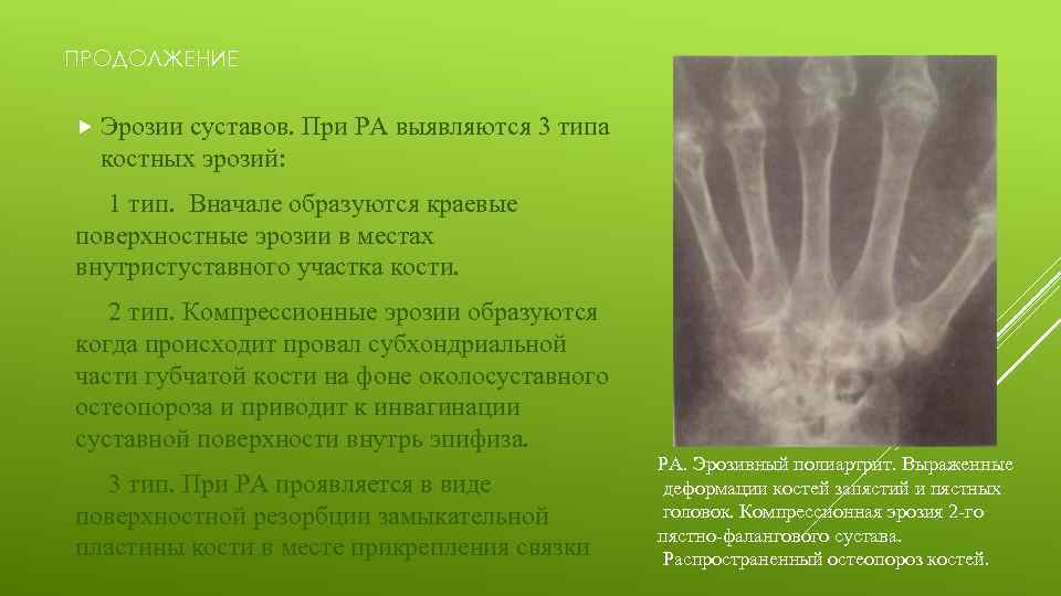 ПРОДОЛЖЕНИЕ Эрозии суставов. При РА выявляются 3 типа костных эрозий: 1 тип. Вначале образуются