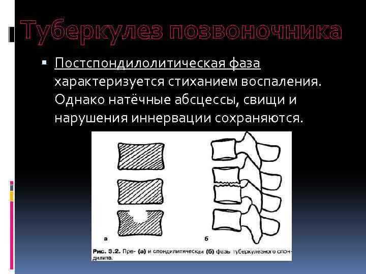 Туберкулез позвоночника Постспондилолитическая фаза характеризуется стиханием воспаления. Однако натёчные абсцессы, свищи и нарушения иннервации