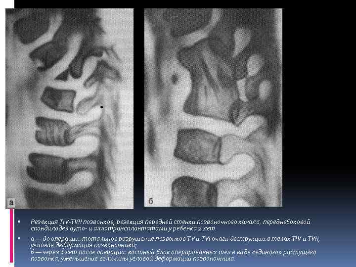  Резекция TIV-ТVII позвонков, резекция передней стенки позвоночного канала, переднебоковой спондилодез ауто- и аллотрансплантатами