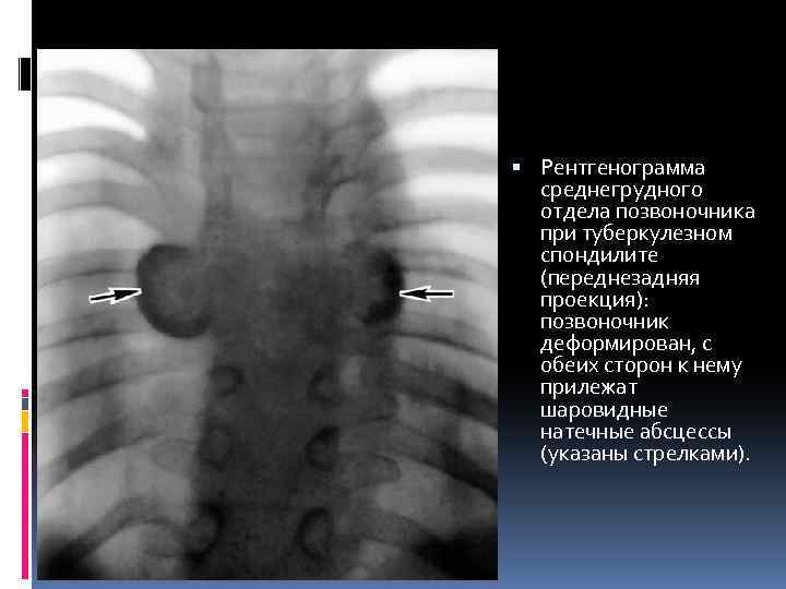  Рентгенограмма среднегрудного отдела позвоночника при туберкулезном спондилите (переднезадняя проекция): позвоночник деформирован, с обеих