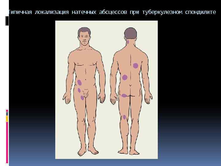 Типичная локализация натечных абсцессов при туберкулезном спондилите 