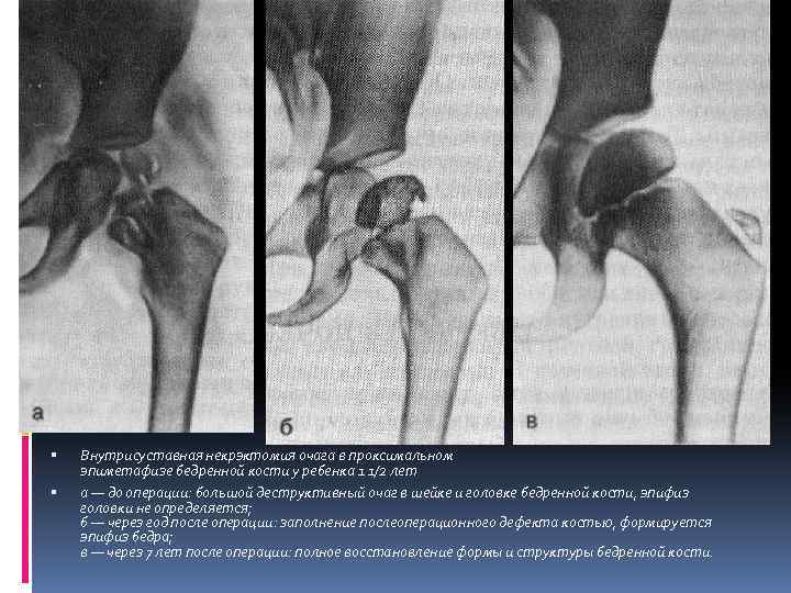  Внутрисуставная некрэктомия очага в проксимальном эпиметафизе бедренной кости у ребенка 1 1/2 лет