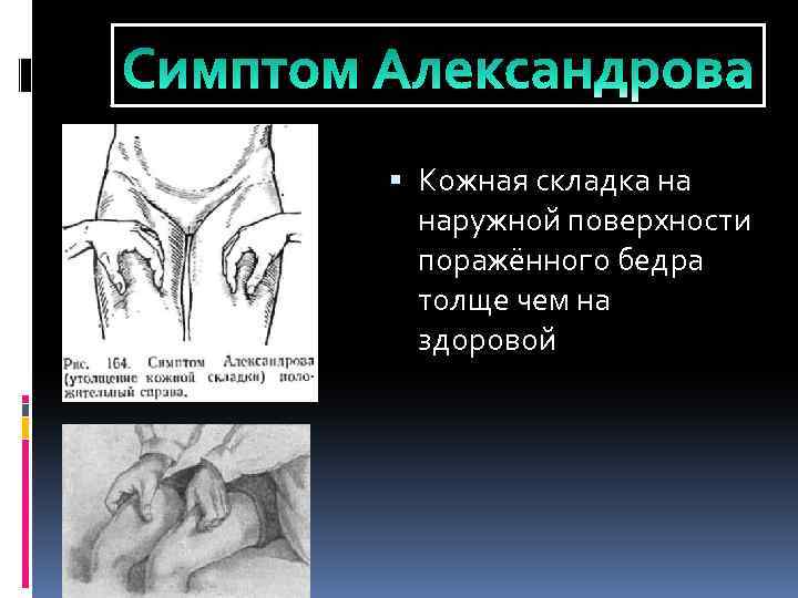  Кожная складка на наружной поверхности поражённого бедра толще чем на здоровой 