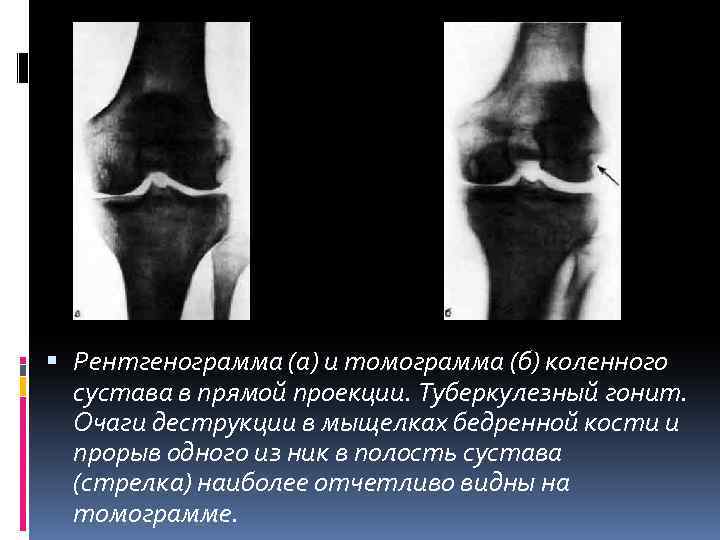  Рентгенограмма (а) и томограмма (б) коленного сустава в прямой проекции. Туберкулезный гонит. Очаги