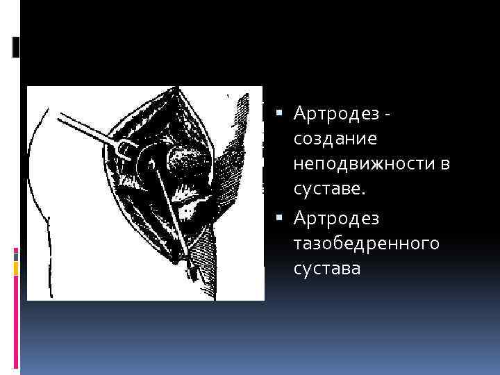  Артродез - создание неподвижности в суставе. Артродез тазобедренного сустава 