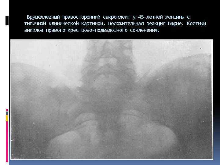  Бруцеллезный правосторонний сакроилеит у 45 -летней женщины с типичной клинической картиной. Положительная реакция