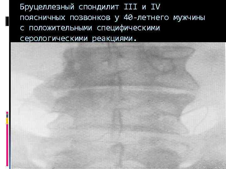 Бруцеллезный спондилит III и IV поясничных позвонков у 40 -летнего мужчины с положительными специфическими