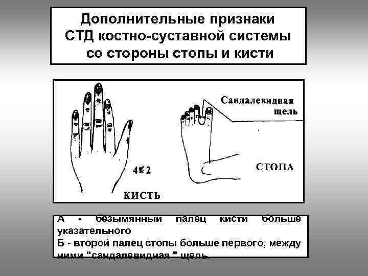 Дополнительные признаки СТД костно-суставной системы со стороны стопы и кисти А - безымянный палец