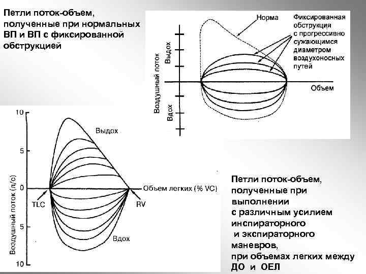 Петли поток-объем, полученные при нормальных ВП и ВП с фиксированной обструкцией Петли поток-объем, полученные