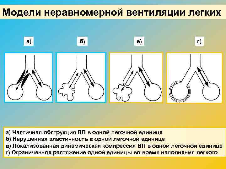 Модели неравномерной вентиляции легких а) б) в) г) а) Частичная обструкция ВП в одной