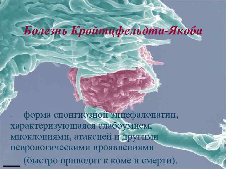 Болезнь Кройтцфельдта-Якоба форма спонгиозной энцефалопатии, характеризующаяся слабоумием, миоклониями, атаксией и другими неврологическими проявлениями (быстро