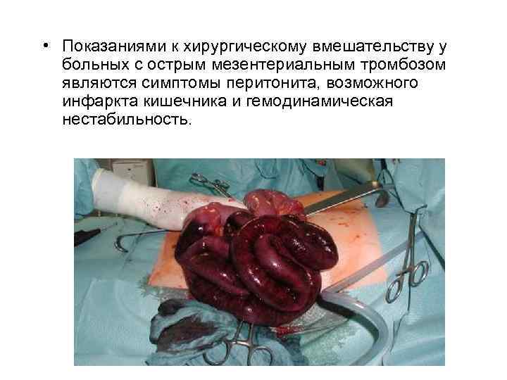  • Показаниями к хирургическому вмешательству у больных с острым мезентериальным тромбозом являются симптомы