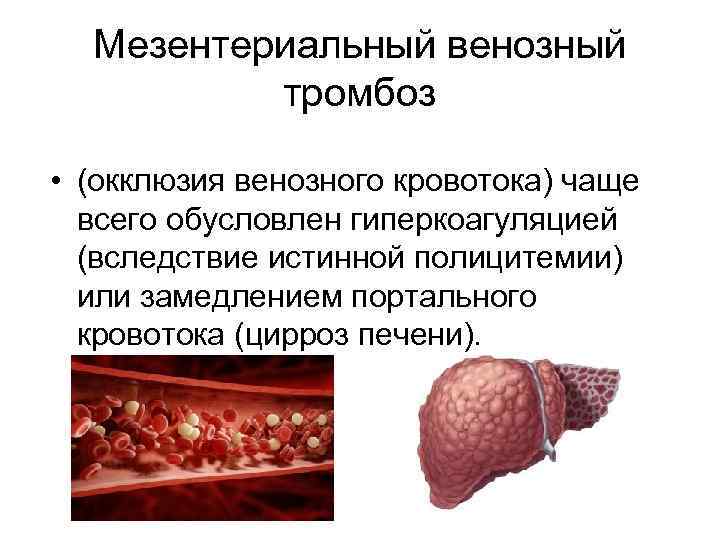 Мезентериальный венозный тромбоз • (окклюзия венозного кровотока) чаще всего обусловлен гиперкоагуляцией (вследствие истинной полицитемии)