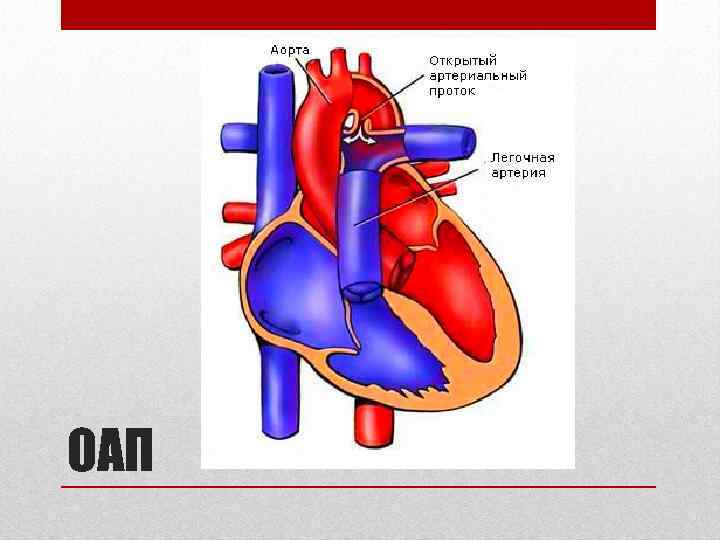 Оап у новорожденных. Открытый артериальный (боталлов) проток. Артериальный боталлов проток соединяет. Открытый артериальный проток Баталов. Открытый артериальный проток (ОАП).