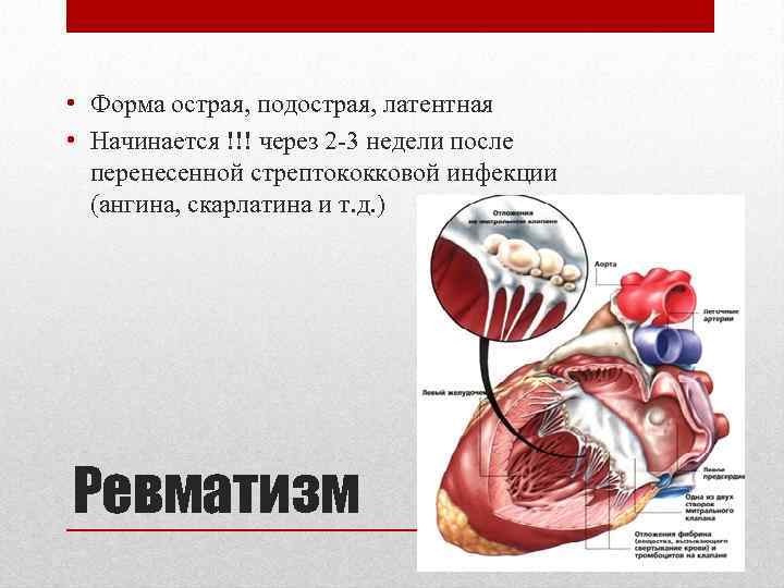  • Форма острая, подострая, латентная • Начинается !!! через 2 -3 недели после