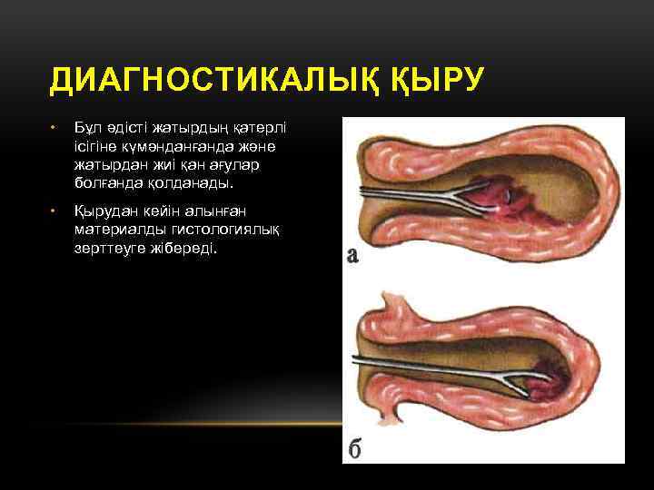 ДИАГНОСТИКАЛЫҚ ҚЫРУ • Бұл әдісті жатырдың қатерлі ісігіне күмәнданғанда және жатырдан жиі қан ағулар