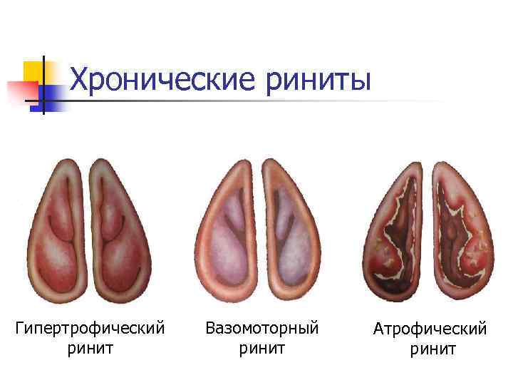 Хронические риниты Гипертрофический ринит Вазомоторный ринит Атрофический ринит 