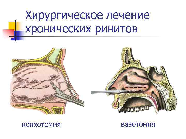 Вазотомия. Вазомоторный ринит носовые раковины. Конхотомия нижних носовых раковин. Вазотомия носовых раковин. Конхопластика носовых раковин.