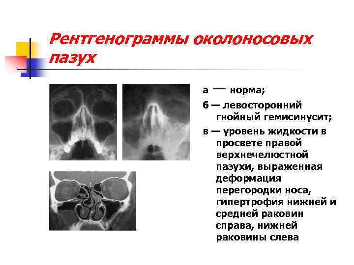 Рентгенограммы околоносовых пазух а — норма; б — левосторонний гнойный гемисинусит; в — уровень