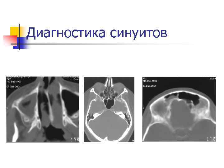 Диагностика синуитов 