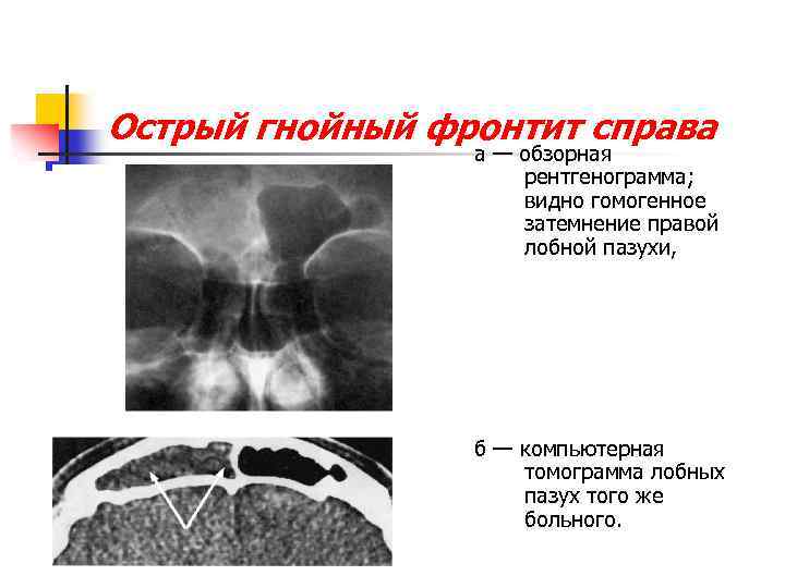 Реферат: Острый левосторонний гнойный фронтит 2