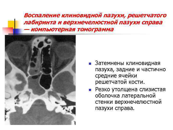 Воспаление клиновидной пазухи, решетчатого лабиринта и верхнечелюстной пазухи справа — компьютерная томограмма n n