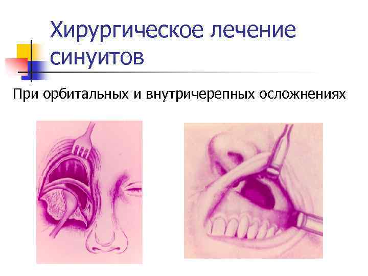 Хирургическое лечение синуитов При орбитальных и внутричерепных осложнениях 