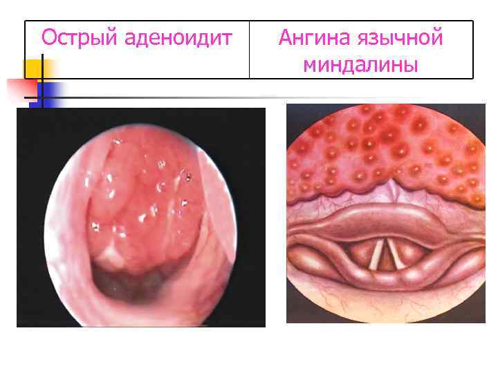 Острый аденоидит Ангина язычной миндалины 