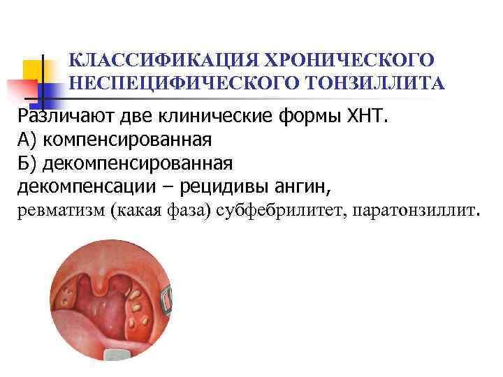 КЛАССИФИКАЦИЯ ХРОНИЧЕСКОГО НЕСПЕЦИФИЧЕСКОГО ТОНЗИЛЛИТА Различают две клинические формы ХНТ. А) компенсированная Б) декомпенсированная декомпенсации