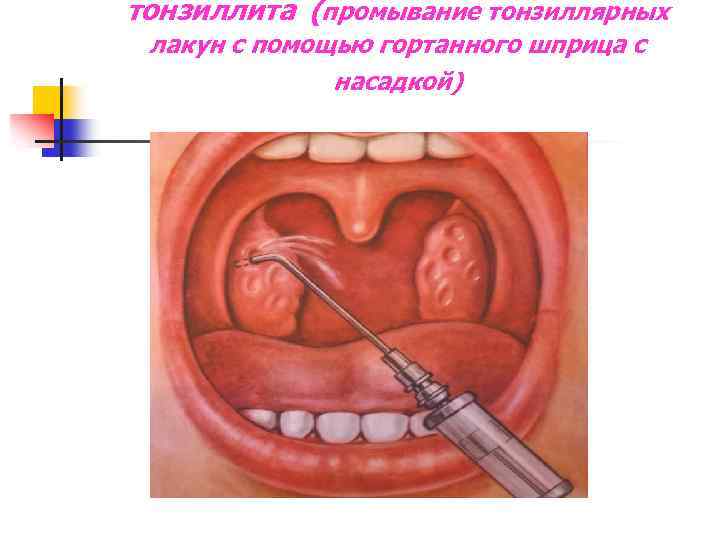 тонзиллита (промывание тонзиллярных лакун с помощью гортанного шприца с насадкой) 