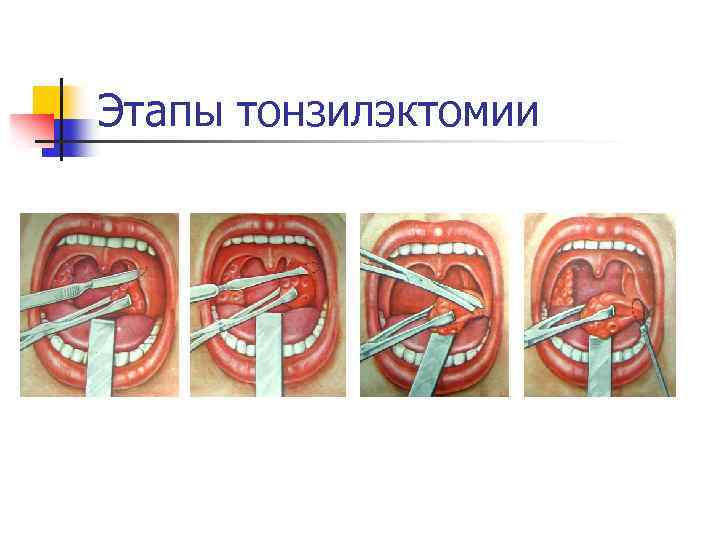 Этапы тонзилэктомии 