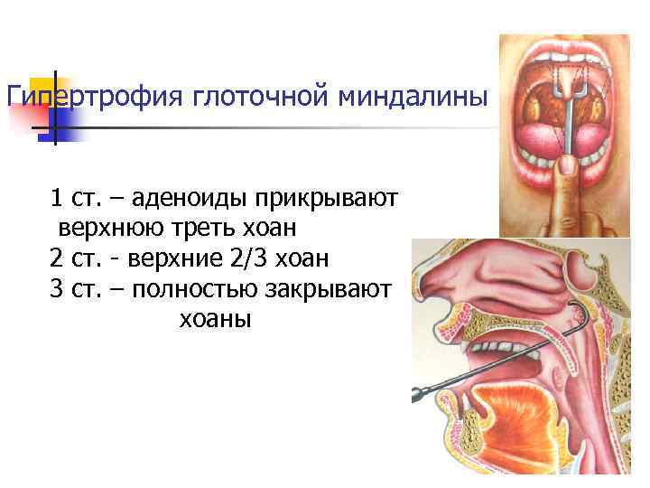 Гипертрофия глоточной миндалины 1 ст. – аденоиды прикрывают верхнюю треть хоан 2 ст. -