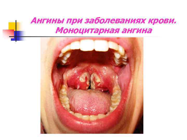 Ангины при заболеваниях крови. Моноцитарная ангина 
