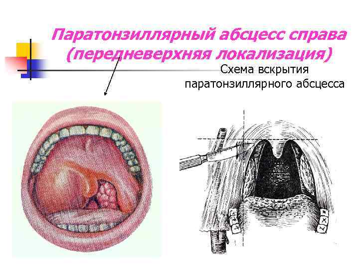 Паратонзиллярный абсцесс справа (передневерхняя локализация) Схема вскрытия паратонзиллярного абсцесса 