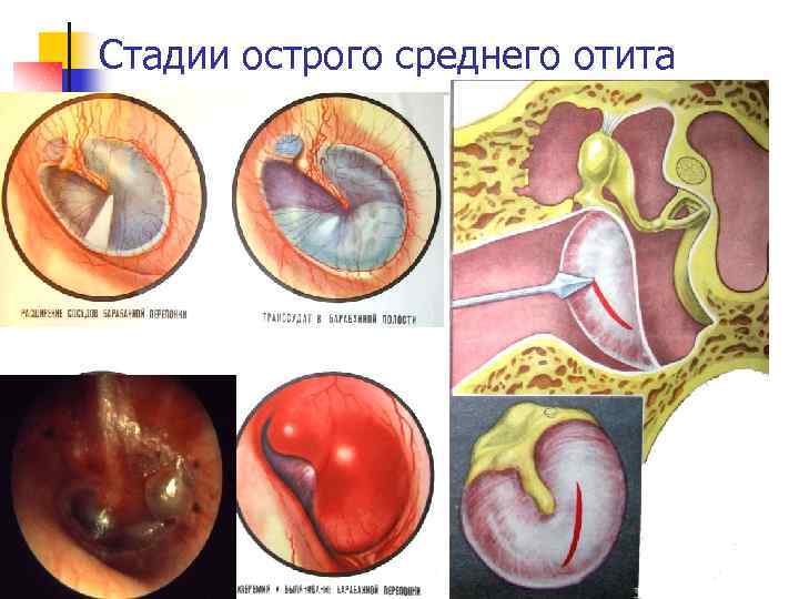 Стадии острого среднего отита 