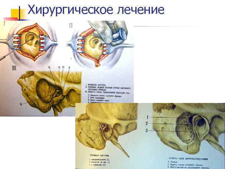Хирургическое лечение 