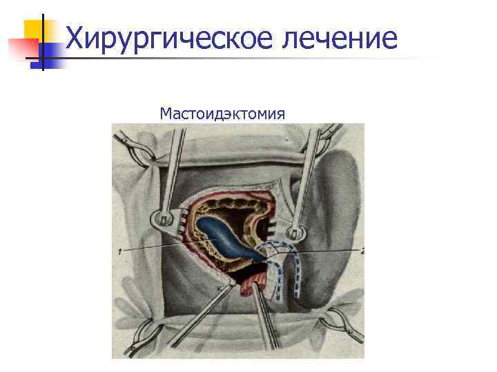 Хирургическое лечение Мастоидэктомия 