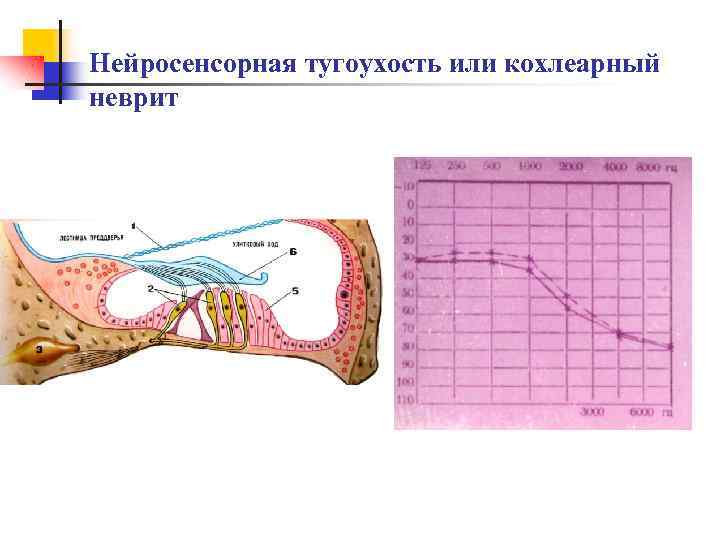 Нейросенсорная тугоухость или кохлеарный неврит 