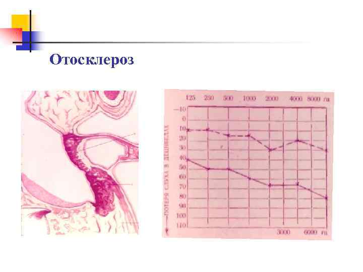 Отосклероз 