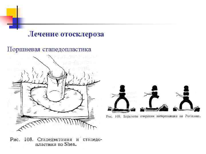 Лечение отосклероза Поршневая стапедопластика 