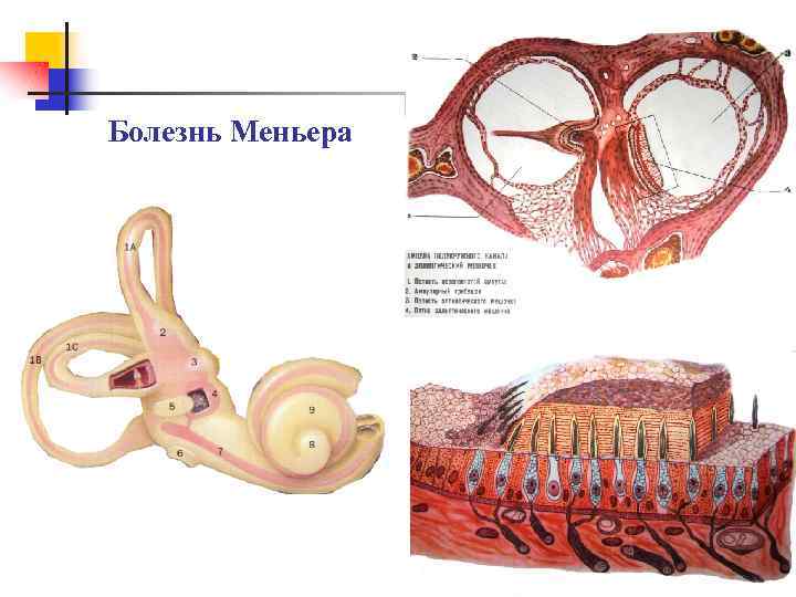 Болезнь Меньера 