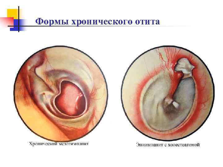 Формы хронического отита 
