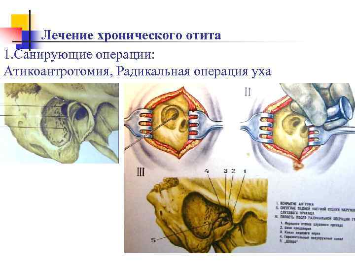 Лечение хронического отита 1. Санирующие операции: Атикоантротомия, Радикальная операция уха 