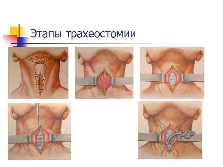 Этапы трахеостомии 