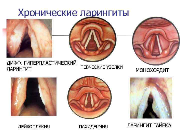 Хронические ларингиты ДИФФ. ГИПЕРПЛАСТИЧЕСКИЙ ПЕВЧЕСКИЕ УЗЕЛКИ ЛАРИНГИТ ЛЕЙКОПЛАКИЯ ПАХИДЕРМИЯ МОНОХОРДИТ ЛАРИНГИТ ГАЙЕКА 