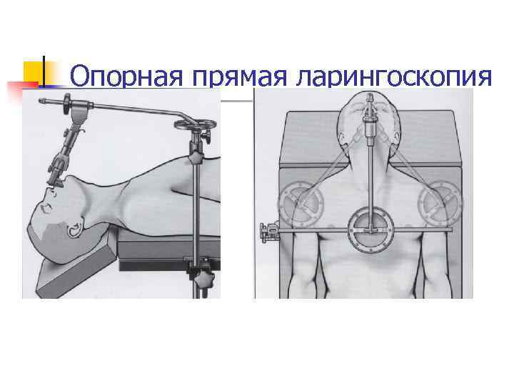 Опорная прямая ларингоскопия 