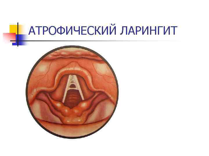 АТРОФИЧЕСКИЙ ЛАРИНГИТ 