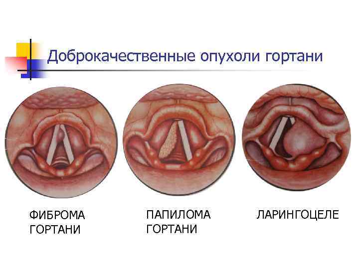 Доброкачественные опухоли гортани ФИБРОМА ГОРТАНИ ПАПИЛОМА ГОРТАНИ ЛАРИНГОЦЕЛЕ 