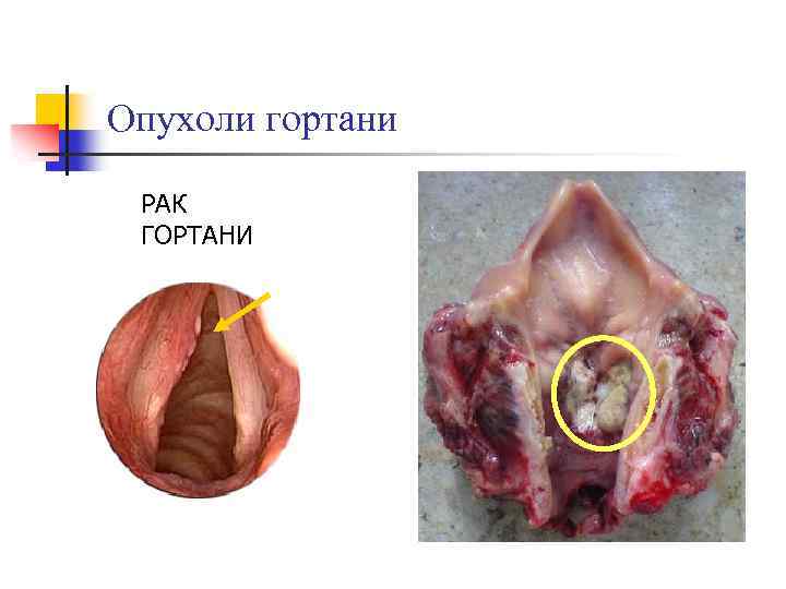 Опухоли гортани РАК ГОРТАНИ 