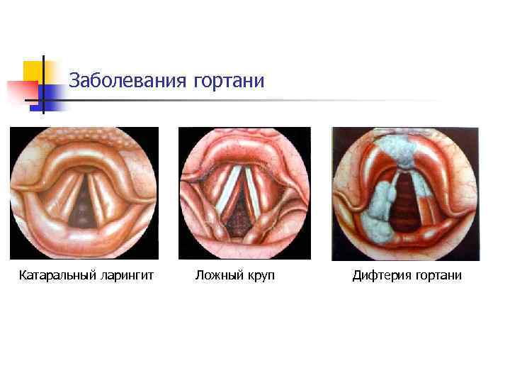 Заболевания горла и гортани фото